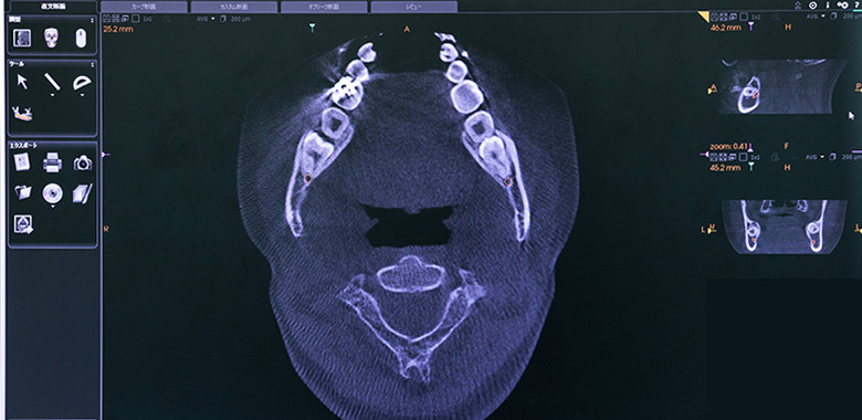デジタルレントゲン（オルソパノラマ、デンタル、顎関節断層）