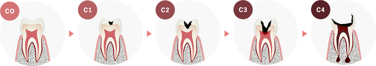 虫歯の進行と治療法