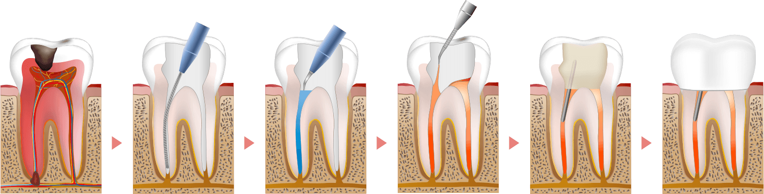 根管治療から補綴の流れ