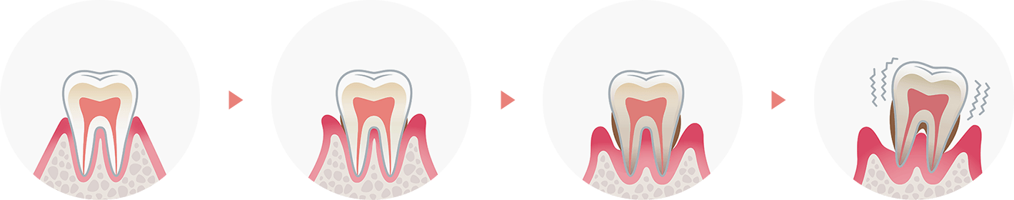 歯周病の進行と治療法